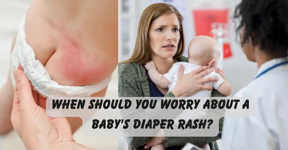 When to Worry and How to Prevent Baby’s Diaper Rash?